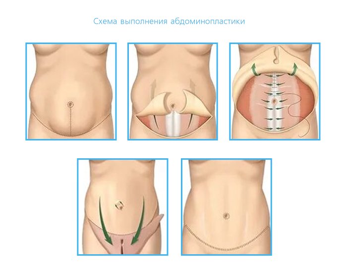 Абдоминопластика - Сеть клиник АО Семейный доктор (Москва) - Изображение 2