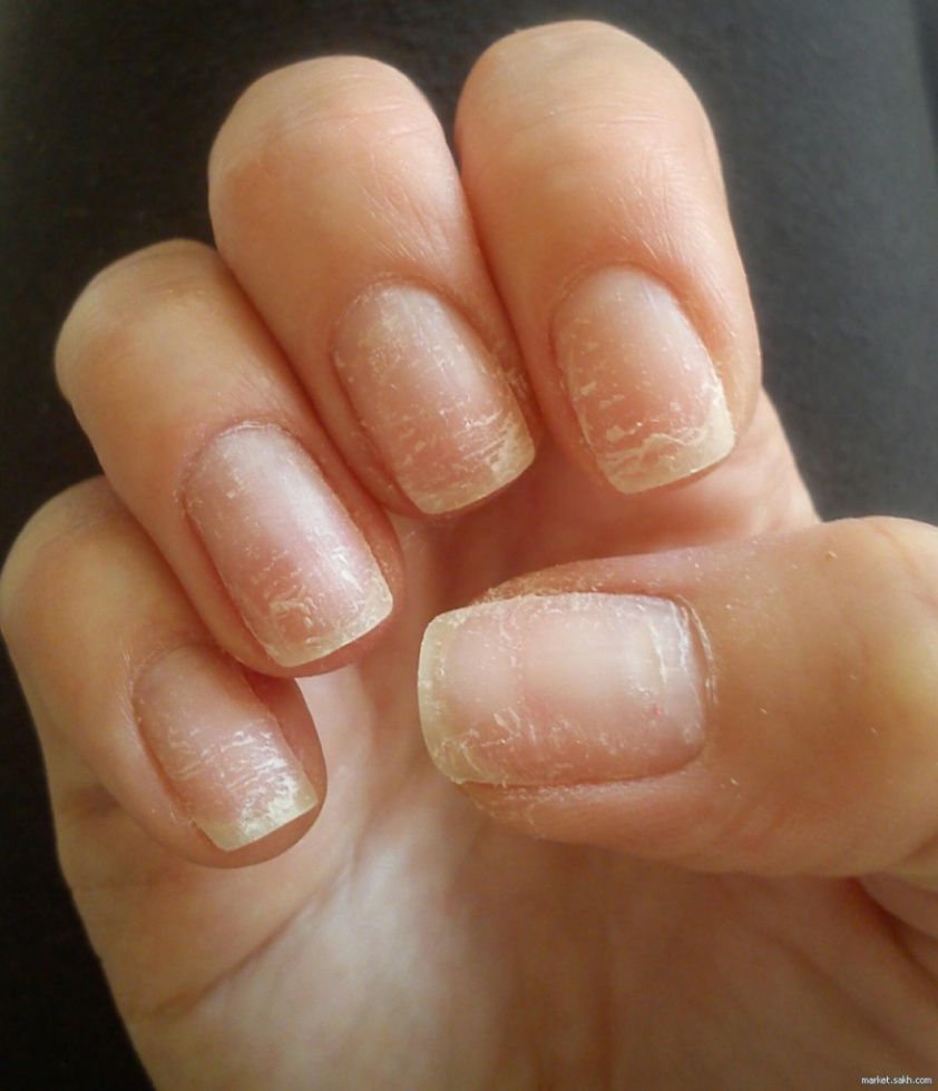 Грибок ногтей - Изображение 2 - лечение микоза ногтей в клинике АО Семейный доктор