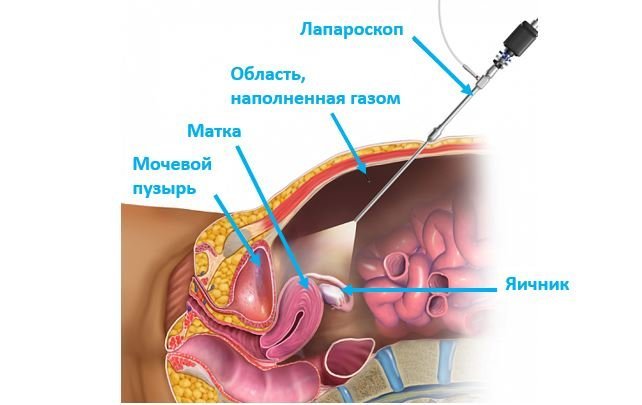 Лапароскопическая резекция яичника