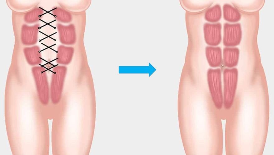 Пластика при диастазе мышц живота