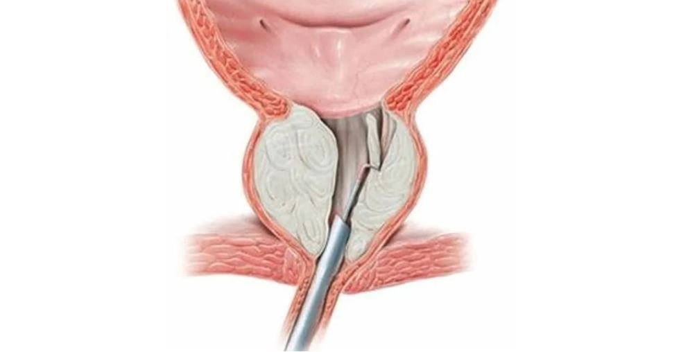 ТУР аденомы простаты