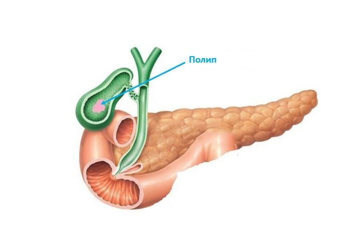 Полипы желчного пузыря