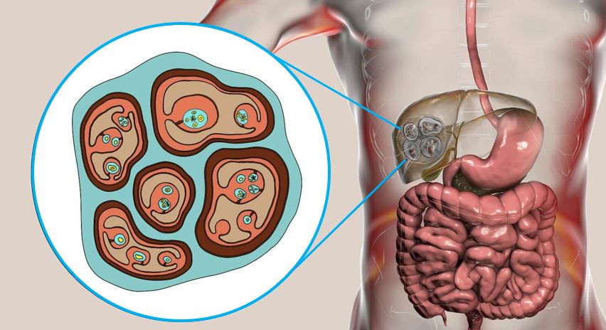 Паразитарные кисты печени