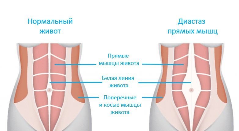 Диастаз прямых мышц живота