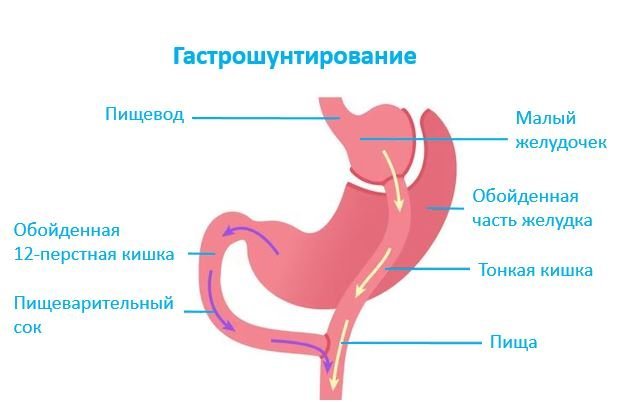 Гастрошунтирование