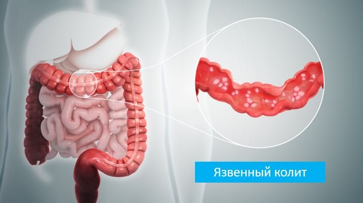 Язвенный колит - Сеть клиник АО Семейный доктор (Москва) - Изображение 1