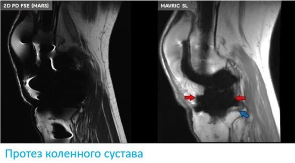 МРТ сустава с протезом - Сеть клиник АО Семейный доктор (Москва) - Изображение 2