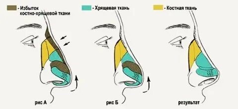 Ринопластика - Сеть клиник АО СЕмейный доктор (Москва) - Изображение 2