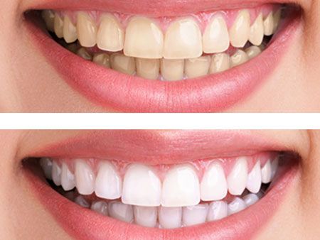 Зубы после отбеливания фото