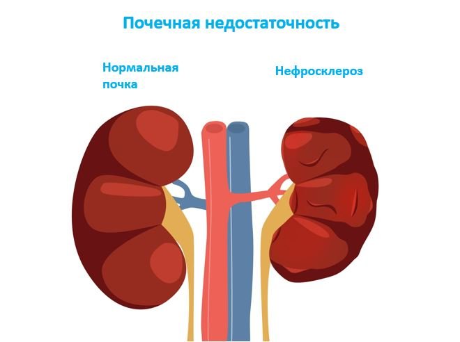 Почечная недостаточность - сеть клиник АО Семейный доктор (Москва) - Изображение 1