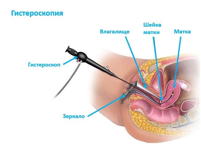 Гистероскопия - Сеть клиник АО Семейный доктор (Москва) - Изображение 1