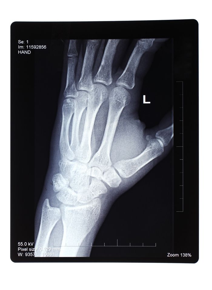 Рентген коленного сустава (2 проекции) - ЕМЦ
