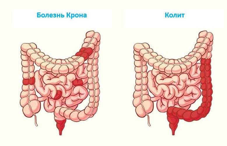 Колит - Сеть клиник АО Семейный доктор (Москва) - Изображение 1