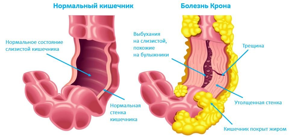 Болезнь Крона - Сеть клиник АО Семейный доктор (Москва) - Изображение 1