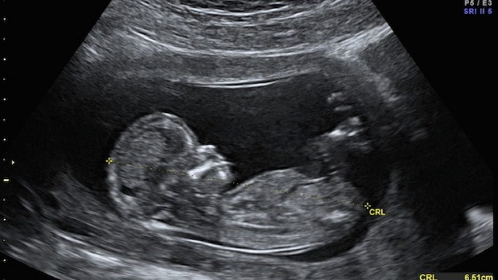 3D и 4D УЗИ при беременности: как получить фото и видео с ребёнком до родов