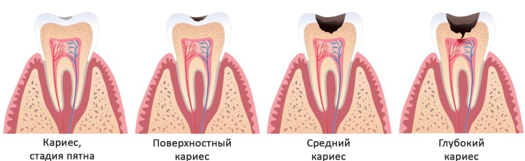 Средний кариес - Сеть клиник АО Семейный доктор (Москва) - Изображение 1